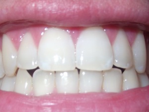 Not my teeth, sorry. Free image appropriated from WikiStealYourResearchIa.